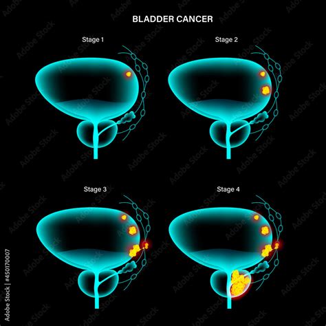 Bladder cancer stages Stock Vector | Adobe Stock