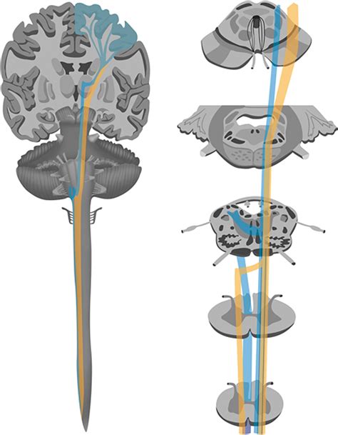 Case Mutation In Robo Genehorizontal Gaze Palsy And Progressive