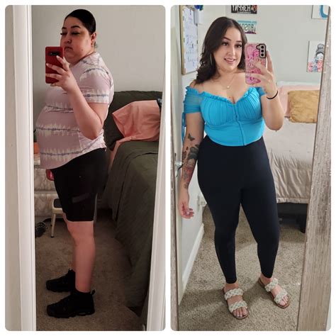 Pituitary Surgery Resolves Cushing's Disease for Barrow Patient