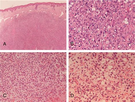 Histologic Features Of Two Cases Of Poorly Differentiated Download