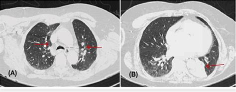 Ct Pulmonary Angiogram A X Cm Left Hilar Nodular Soft Tissue