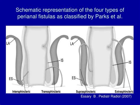 Ppt Fistulising Crohns Des Ease Powerpoint Presentation Free Download Id4492626