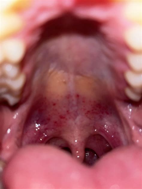 Developed These Red Spots On The Roof Of My Mouth Does Anybody Know