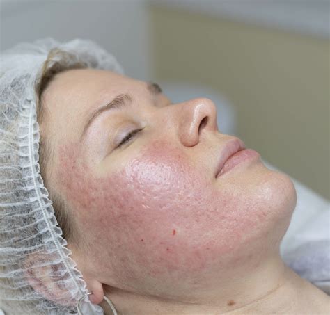 Acne Treatment Devonshire Dermatology London