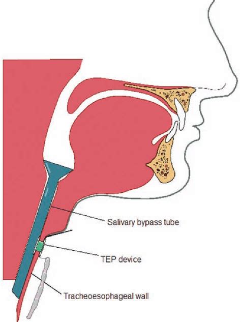 Tracheoesophageal Puncture