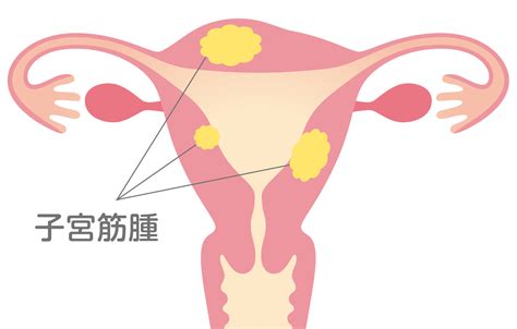 子宮 ちくちく