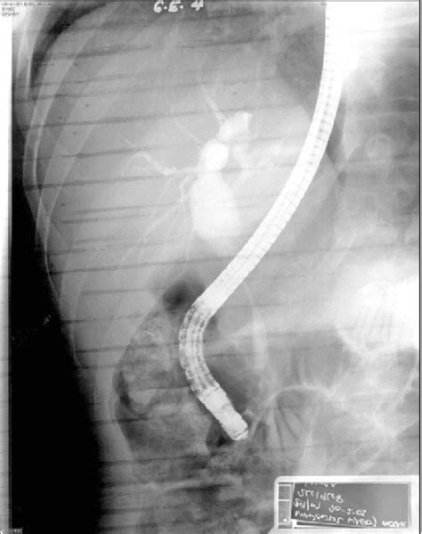 Ercp Showing A Stricture Of The Distal Common Bile Duct With Dilatation Download Scientific