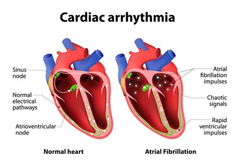 Arrhythmia | Symptoms, Causes, Treatment & Prevention