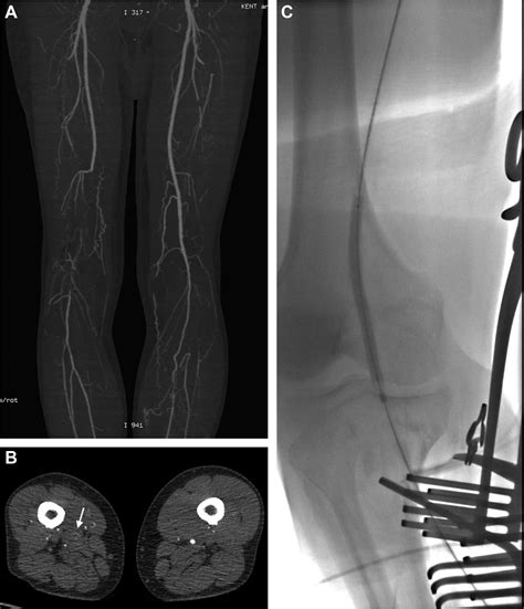 Updated Clinical And Radiological Classification Of Lower Limb