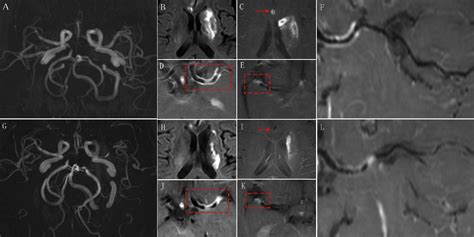 Study On The Clinical Imaging And Pathological Characteristics Of