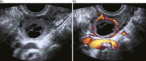 Ovarian Ectopic Pregnancy Ultrasound