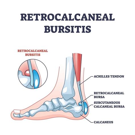 68 Calcaneal Bursitis Royalty-Free Photos and Stock Images | Shutterstock