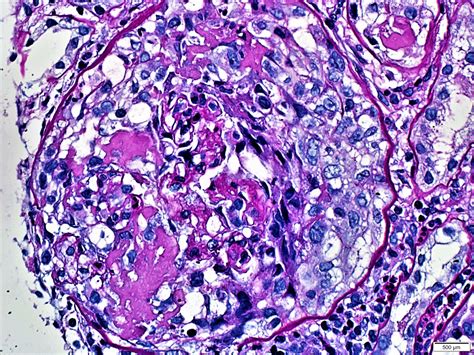 Pathology Outlines - Crescentic glomerulonephritis overview