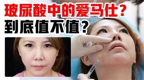 鼻唇沟有救了？乔雅登雅致硬核实测！玻尿酸中的“爱马仕”凭啥这么贵？ Youtube