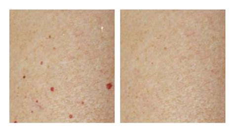 Blood Spot Removal - Services - Renew Skin Clinic