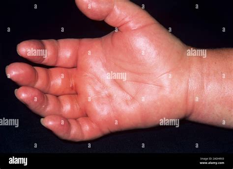 Wasp Sting Swollen Hand Of A 61 Year Old Woman Caused By A Wasp Sting