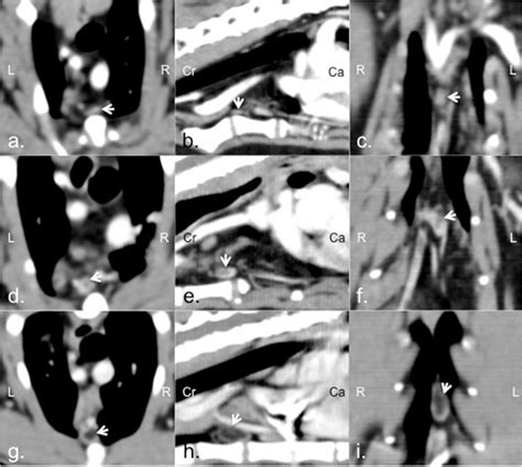 The Presence Of Intra Thoracic Lymph Nodal Hilus Fat On Each Plane Of