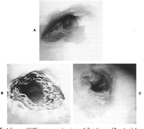 Figure From Combination Of Endoscopic Argon Plasma Coagulation And