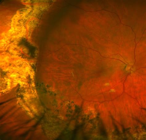 Retinal Detachment Associated Retinal Consultants P C