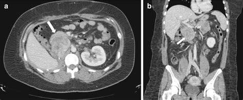 Retroperitoneum Radiology Key