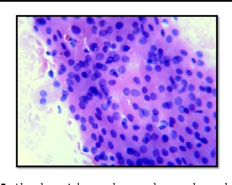 Figure 5 from Fine Needle Aspiration Cytology in Warthin's Tumor: A ...