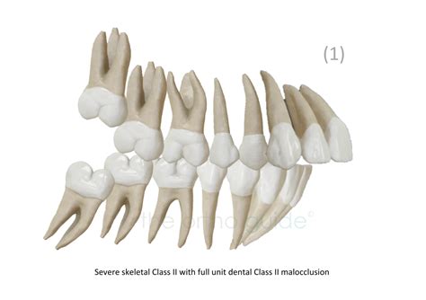 Decompensation Orthodontics And Mandibular Advancement Surgery For Class Ii The Ortho Guide