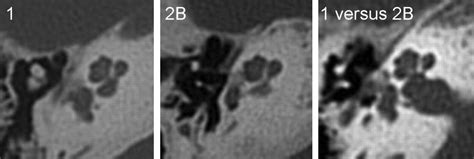 Ct Grading Of Otosclerosis American Journal Of Neuroradiology