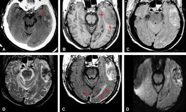 Brain Contusion Imaging: Practice Essentials, Computed Tomography, Magnetic Resonance Imaging