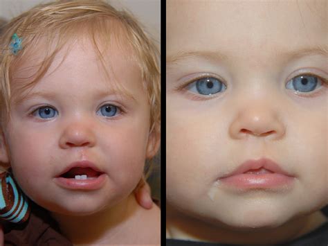 Cleft Lip Surgery Before And After