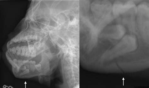 Lateral Pterygoid Plate Radiograph