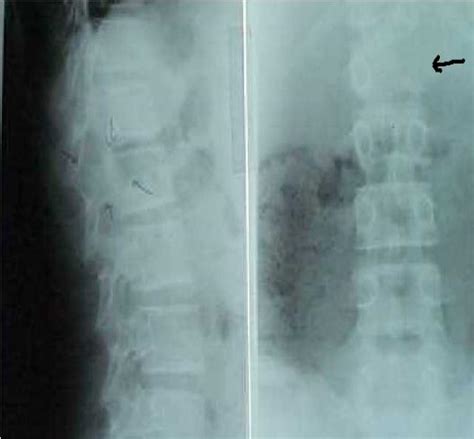 AJNS – African Journal of Neurological Sciences | » ANEURYSMAL BONE CYST OF THE SPINE