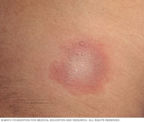 Lyme Borreliose Ursachen Symptome Und Behandlung Medde