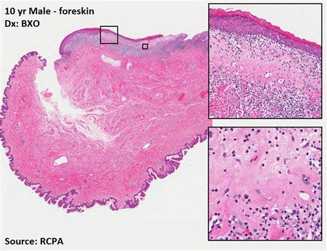 Balanitis Xerotica Obliterans Histology