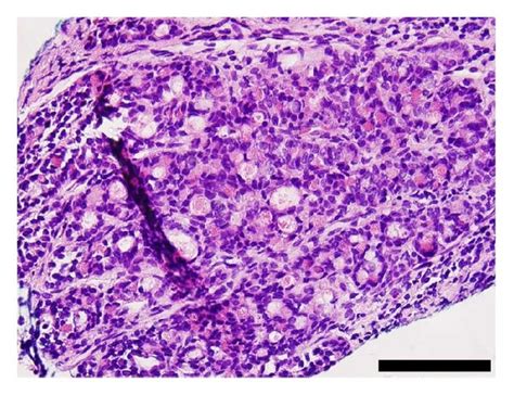 Histologic And Immunophenotypic Features Of Tlfck On Biopsy A Low