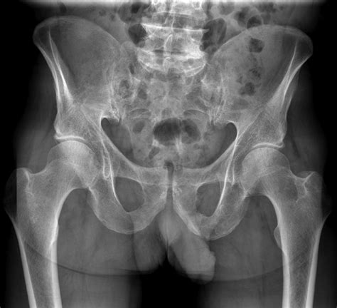 Osteoarthritis Mri