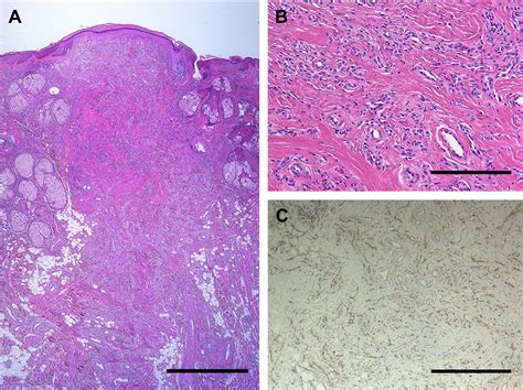 Figure 1 From A Case Of Microvenular Hemangioma With Presentation