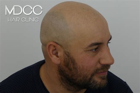 Avn Micropigmentation Cheveux Paris Marseille Toulon Et Toulouse