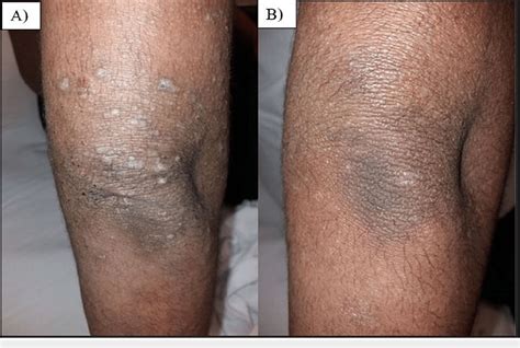 Figure 1 From Misdiagnosed Pityriasis Rubra Pilaris Successfully