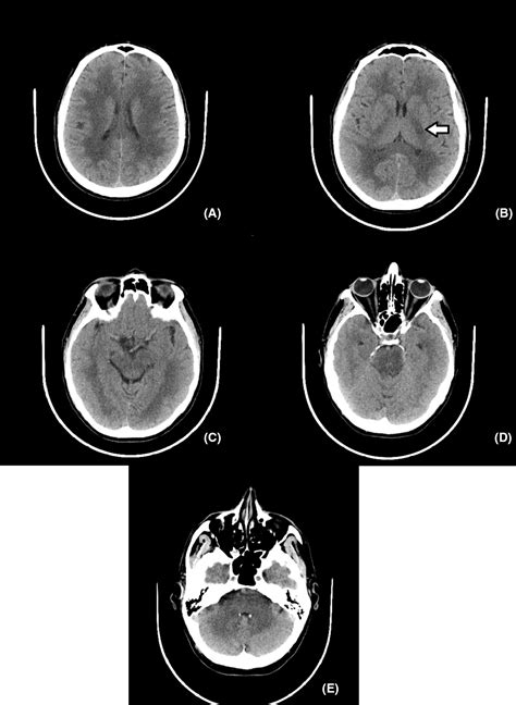 Binswanger S Disease Case Presentation And Differential Diagnosis Văcăraș 2020 Clinical