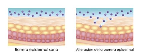 Dermatitis Por Malassezia