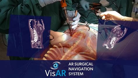 First Fully Immersive 3d Augmented Reality Surgical Navigation System