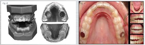 Tads Case Presentation By Dr John M Pobanz Orthotown