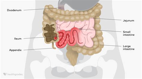 Ileitis: Definition, Causes, Symptoms, and Treatments