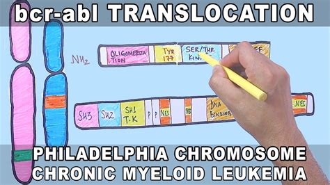 Philadelphia Chromosome [Ph] – Introduction, variants of BCR ABL gene ...