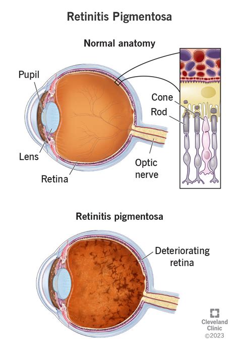 Retinitis Pigmentosa