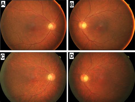 Fundus Photographs Of A Patient Diagnosed With Carcinoma Associated Download Scientific Diagram