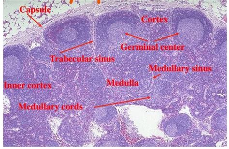 Pin de Dr G Hassan en lymph nodes Histología Anatomia patologica