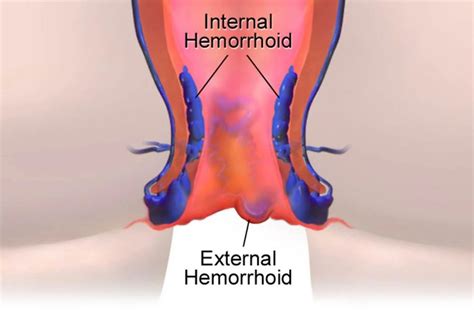 Haemorrhoids Anal Fissures Fistulas VIPLaserClinicMedSpa