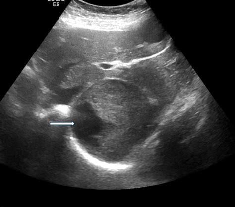 Adrenal Haematoma Versus Liver Cyst Discrimination By Contrast