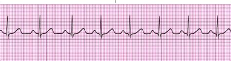 EKG rhythm strips Flashcards | Quizlet